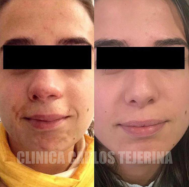 Dr. Carlos Tejerina rinoplastia